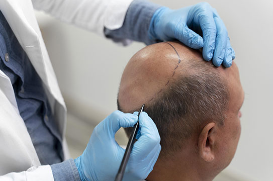 Hair Transplant best hair transplant in hyderabad