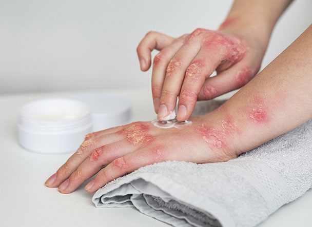 urticaria treatment in hyderabad