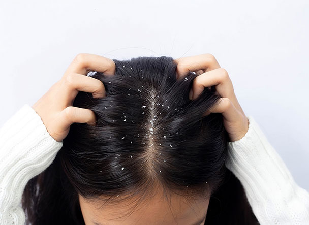 dandruff treatment in hyderabad