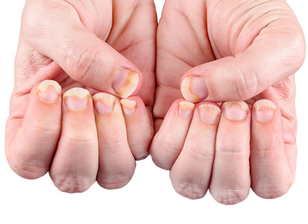 Treatment for Nail Disorders
